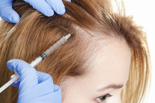 Проблемы волос решит мезотерапия