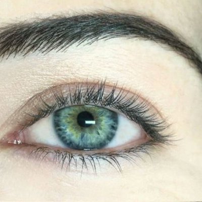 Блефаропластика