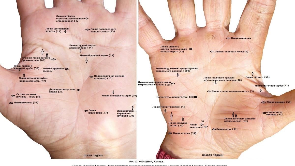 Рис.12. Сахарный диабет 1 и 2 типа