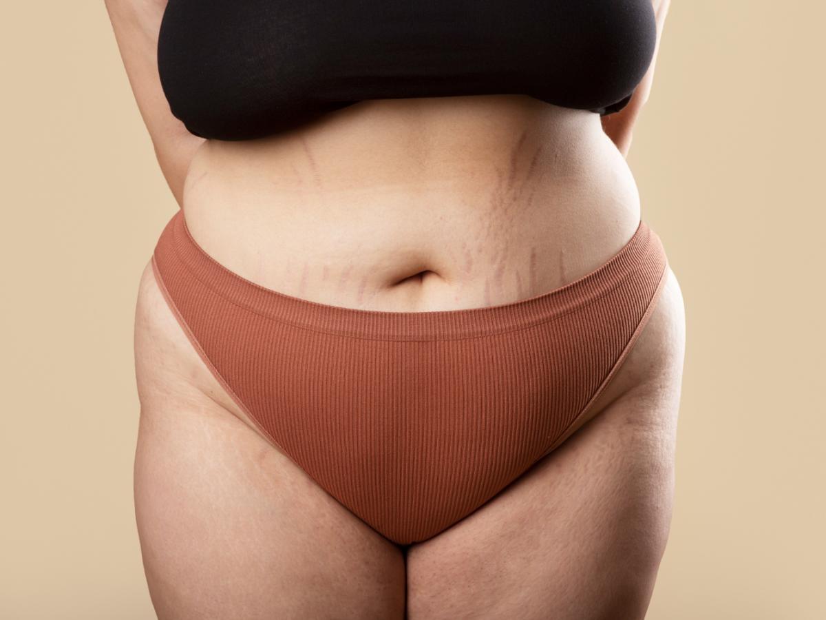 Эффект Скарлетт Йоханссон: как голливудский лазер стирает растяжки за 4 визита