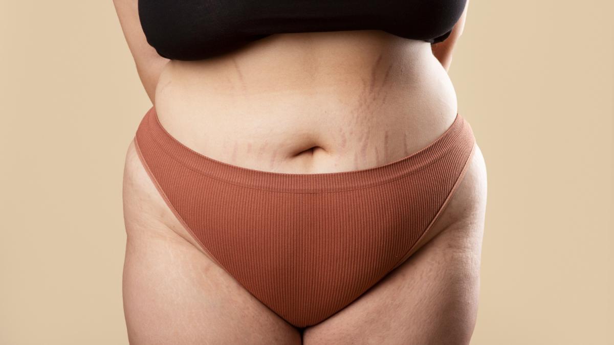 Растяжки на теле