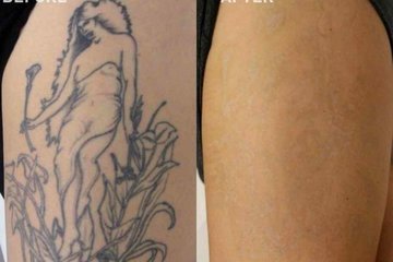 Татуировка надоела: способы, как от неё избавиться