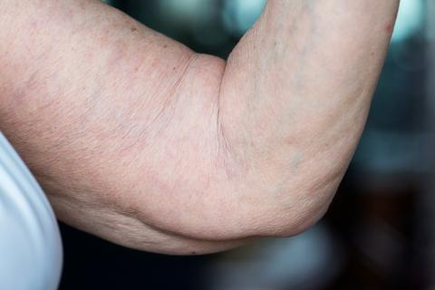 3 эффективных метода лечения сосудистых 