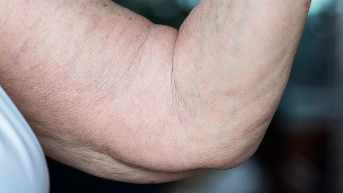 Сосудистые звёздочки