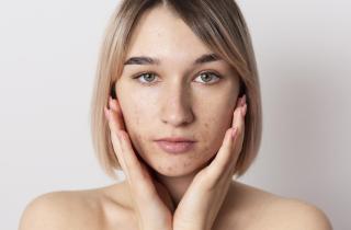 Мед и аспирин: секреты мгновенного избавления от акнэ