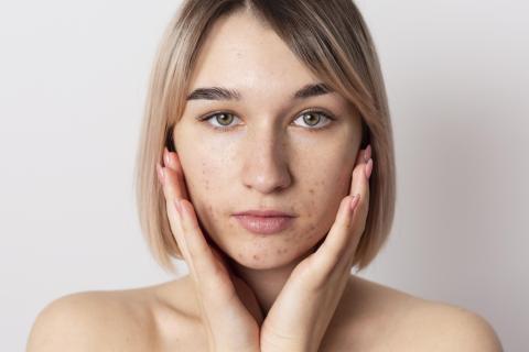 Мед и аспирин: секреты мгновенного избавления от акнэ