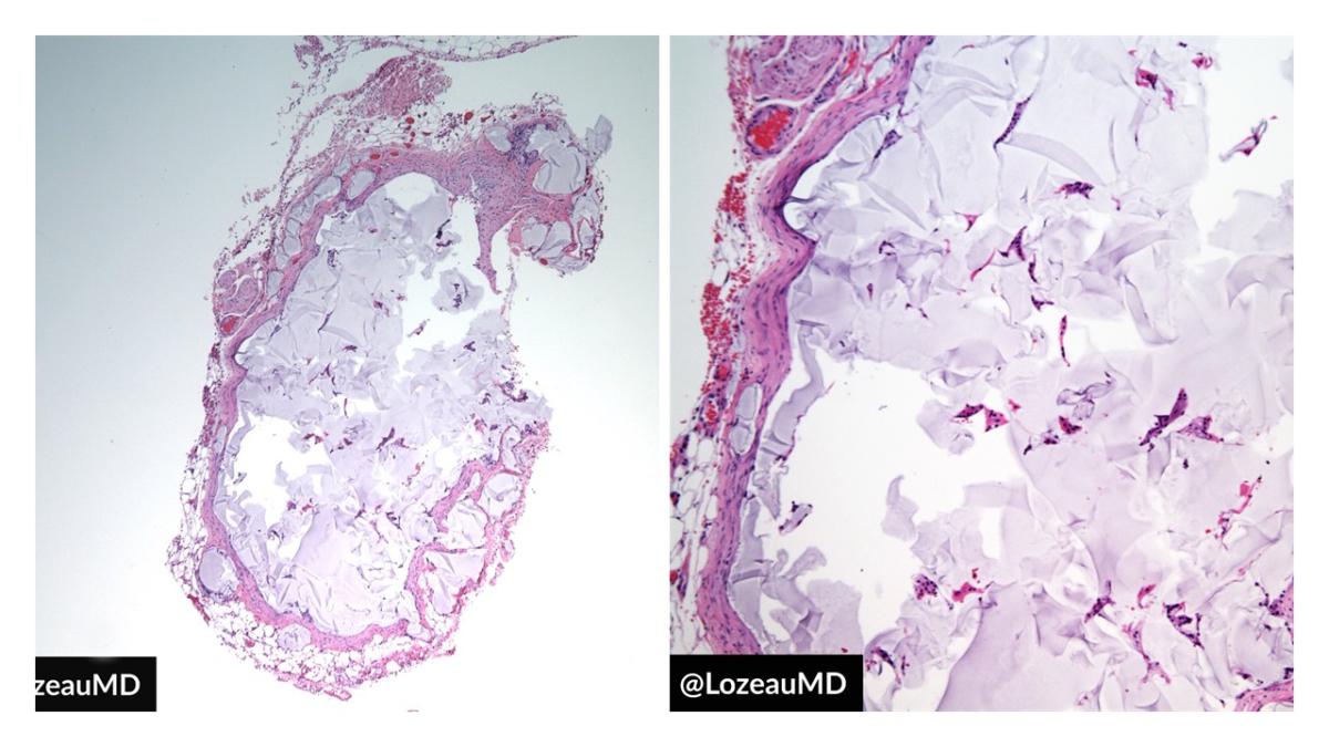 Гиулуроновая кислота