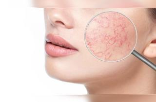 Купероз после 25: как остановить покраснения и укрепить сосуды – советы врачей