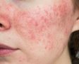 Как рано распознать 4 опасных заболения кожи лица и избежать осложнений